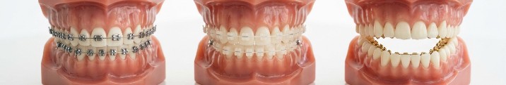Брекеты после 30 лет у взрослых: эффективность, результаты и особенности установки